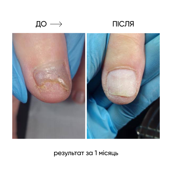 NAILSOFTHEDAY OniStop - олія для лікування оніхолізсу, 15 мл