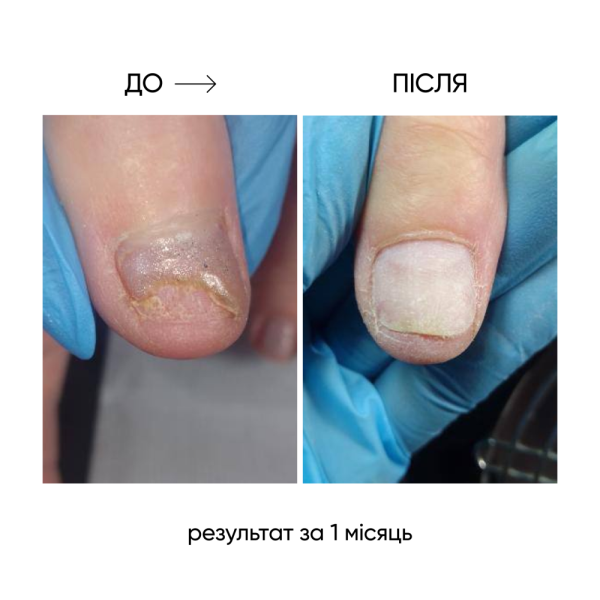 NAILSOFTHEDAY OniStop - олія для лікування оніхолізсу, 15 мл