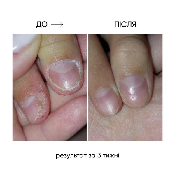 NAILSOFTHEDAY OniStop - олія для лікування оніхолізсу, 15 мл