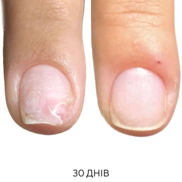 NAILSOFTHEDAY OniStop - олія для лікування оніхолізсу, 8 мл