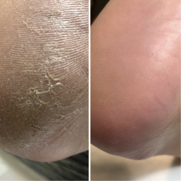 Крем від тріщин для рук та стоп Resultum Anti Crack Cream Jojoba з жожоба, 25 мл